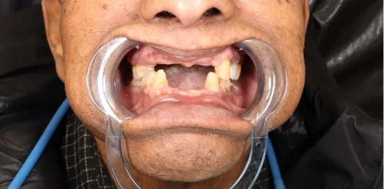 partial dentures before