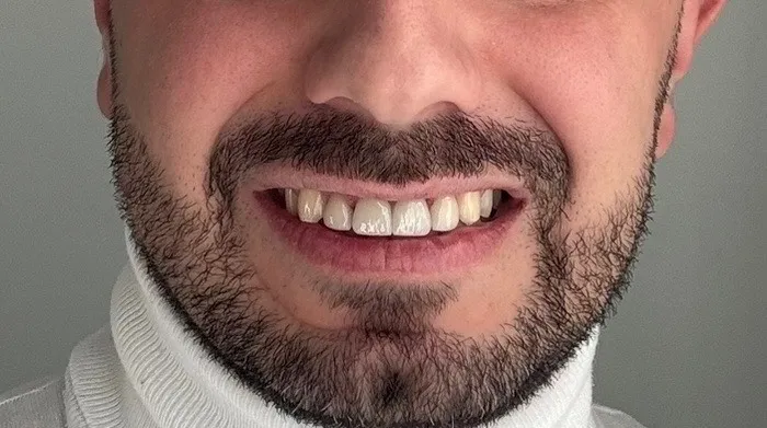 after smile makeover in Orleans