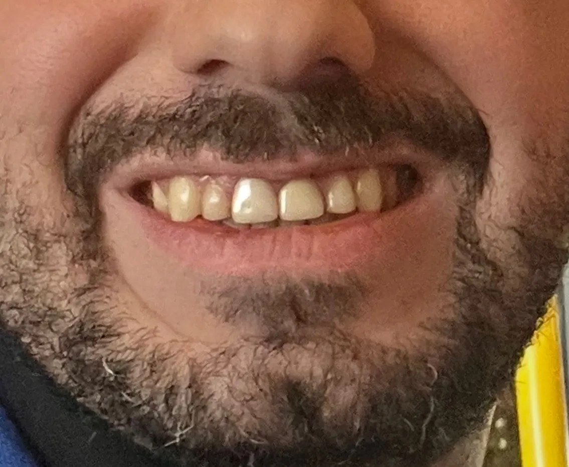 Before smile makeover in Orleans