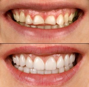 before & after Veneers